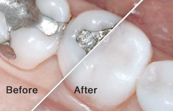 Before and After mercury free restorations